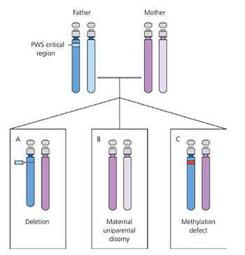 sindrome di prader-willi-schema.jpg