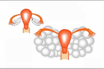 Sindrome da iperstimolazione ovarica : sintomi, cause, diagnosi e cure