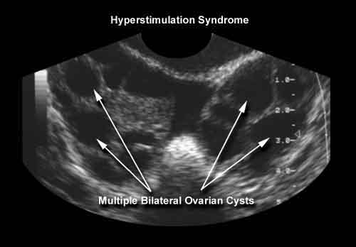 sindrome iperstimolazione ovarica in ecografia.jpg