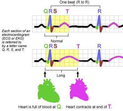 sindromeqt1.gif