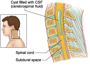 Siringomielia : sintomi, cause, diagnosi e chirurgia