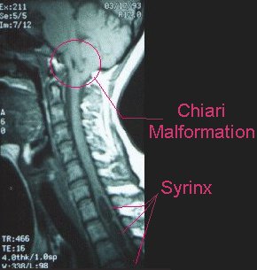 siringomielia_ malfomrazione di Chiari1.jpg