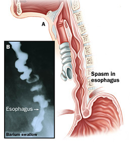 spasmo esofageo1.jpg