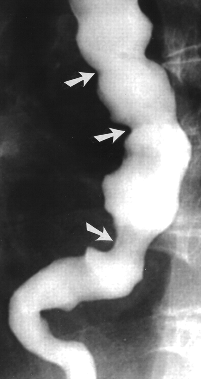 spasmo sofageo visione con bario 21.jpg