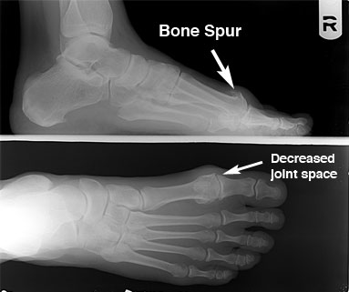 sperone osseo21.jpg