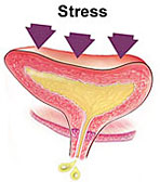 stress-incontinence-sm-bdy.jpg