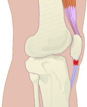 tendinite rotulea2.jpg