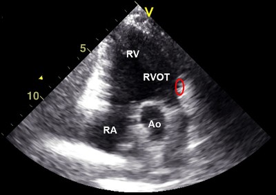 tetralogia di Fallot eco21.jpg