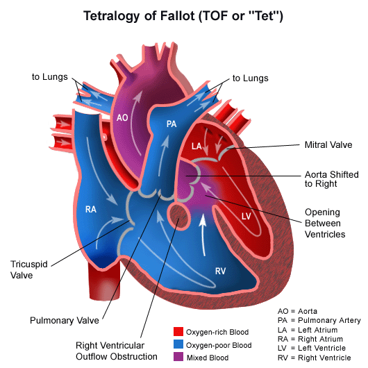 Tetralogia di Fallot : sintomi, cause, diagnosi e cure