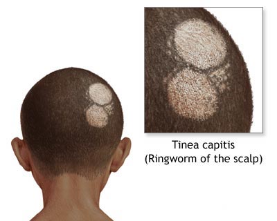 tinea21.jpg