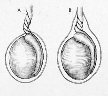 torsione testicolare1.jpg