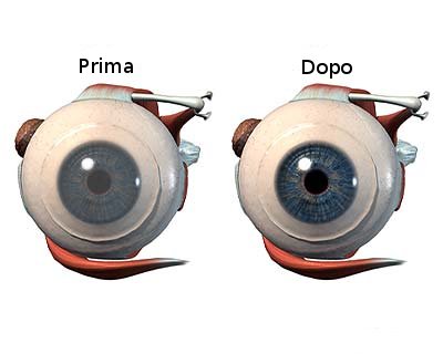 trapianto della cornea.jpg