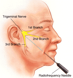 trigemino.gif