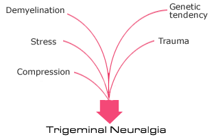 trigemino1compressione.gif