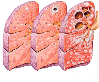 La tubercolosi: sintomi, segni, cure e diagnosi