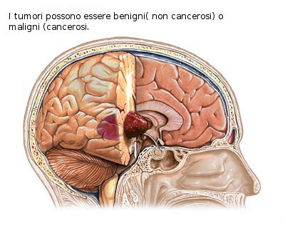 tumori del cervello000.jpg