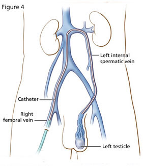 Varicocele : sintomi, cause, chirurgia e diagnosi