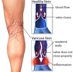 vene varicose.jpg