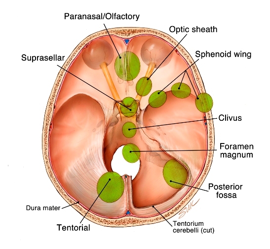 zone meningioma1.jpg