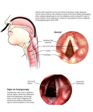 laringite da rreflusso.JPG