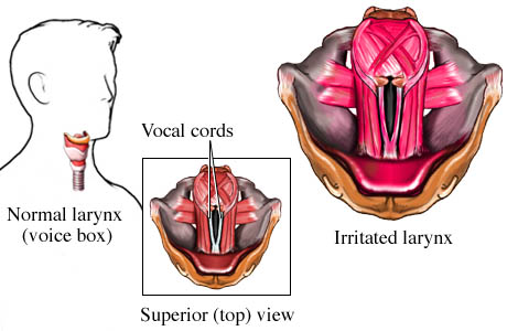 Laringite