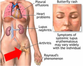 malattia lupus.jpg