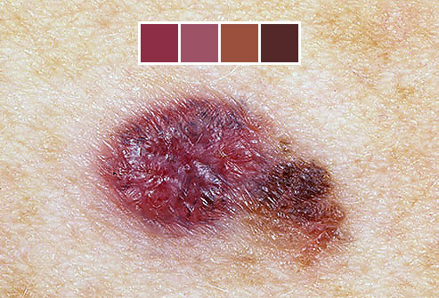 melanoma foto.jpg