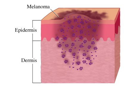 melanoma.jpg