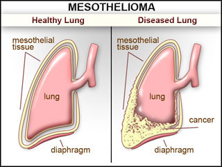 mesotelioma