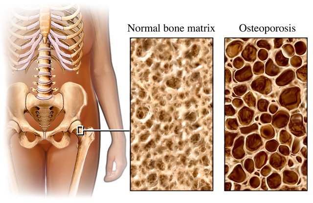 osteoporosi immagine esplicativa.jpg