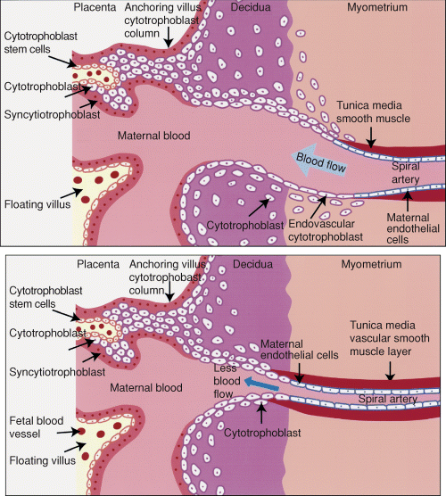 Preeclampsia