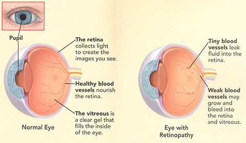 retinopatia diabetica.jpg