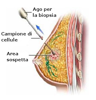 sonda per biopsia del seno.jpg