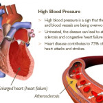 Ipertensione : sintomi, segni, cause, diagnosi e cure