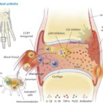 rp_artrite-rumatoide.jpg