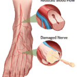 rp_neuropatia-diabetica.gif