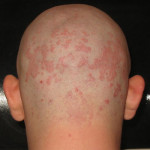 Dermatite seborroica: cosa significa e come si cura