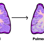 Edema polmonare : cause e sintomi