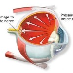 rp_glaucoma.jpg