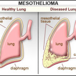rp_mesothelioma.jpg