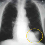 Tumore ai polmoni : chiarezza e terapie