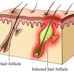 rp_follicolite.jpg