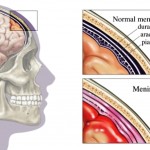 rp_meningite.jpg