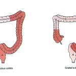 rp_morbo-di-crohn.jpg