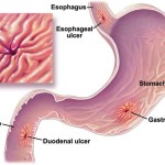 Ulcera peptica: esami e terapie