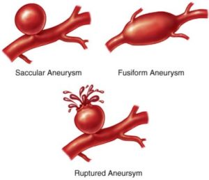 Aneurisma
