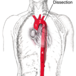 La dissezione dell'aorta: una grave emergenza