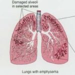 Enfisema polmonare: segni sintomi e terapie