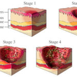 rp_piaghe-da-decubito.jpg