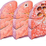 La tubercolosi: sintomi, segni, cure e diagnosi rp_tuberculosi.jpg
